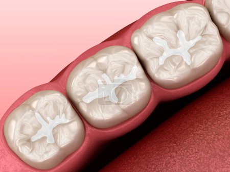 Molar Fissure dental fillings. Dental 3D illustration