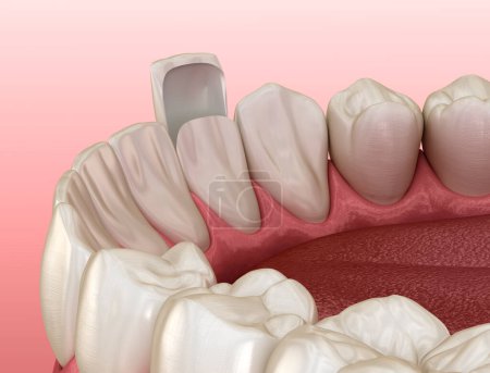 Procedimiento de colocación de chapa dental. Ilustración dental 3D