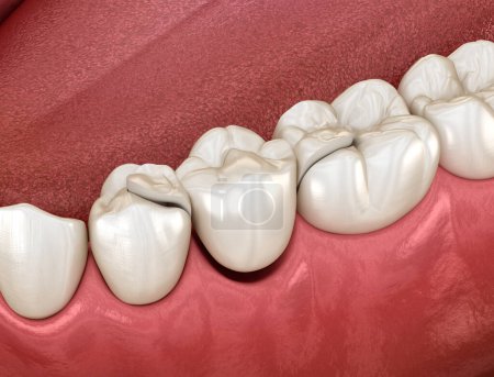 Pont Maryland en céramique, récupération de dents prémolaires. Illustration 3D dentaire