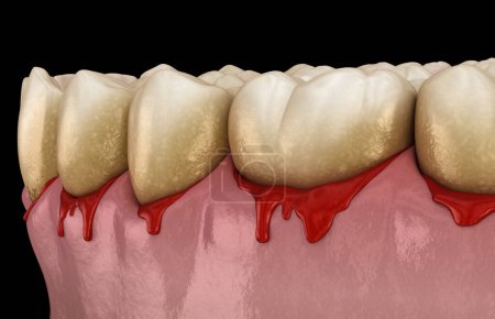 Photo for Bleeding gums or Periodontal - pathological inflammatory condition of the gum and bone support. Dental 3D illustration - Royalty Free Image