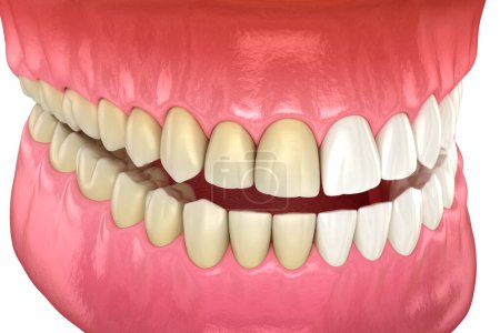 Foto de Blanqueamiento dental - antes y después. Ilustración dental 3D - Imagen libre de derechos