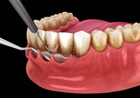 Curetaje abierto: Escalado y cepillado radicular (terapia periodontal convencional). Ilustración dental 3D
