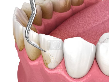 Photo pour Hygiène buccale : Mise à l'échelle et rabotage radiculaire (thérapie parodontale conventionnelle). Illustration 3D dentaire - image libre de droit