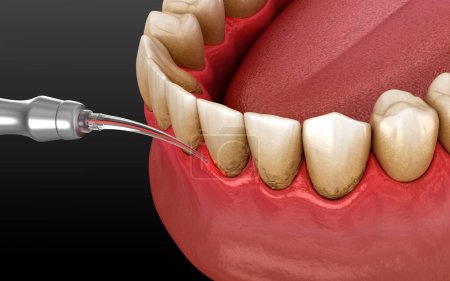 Photo for Laser removes tartar and thin layer of infected skin, teeth cleaning. Dental 3D illustration - Royalty Free Image