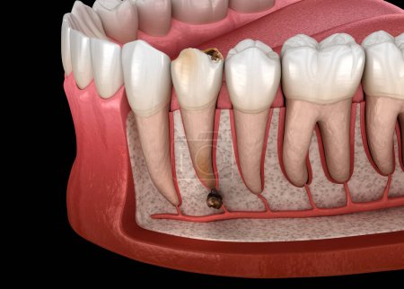 Périostite dentaire - Saute sur la gencive au-dessus de la dent. Illustration dentaire 3D