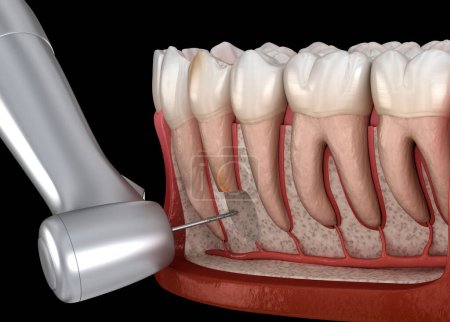 Foto de Cirugía de cistectomía dental: recuperación después de la periostitis. Ilustración dental 3D - Imagen libre de derechos