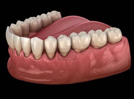 Photo for Gum recession process. Dental 3D illustration - Royalty Free Image