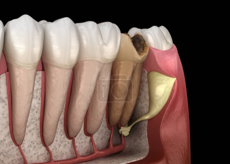 Foto de Diente de periostitis: bulto en la encía por encima del diente. Ilustración dental 3D - Imagen libre de derechos