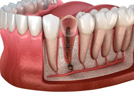Photo for Periostitis tooth - Lump on Gum Above Tooth. Dental 3D illustration - Royalty Free Image