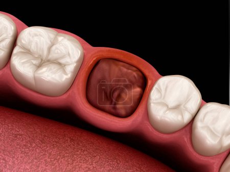 Le caillot de sang scelle la dent après extraction. Illustration 3D dentaire