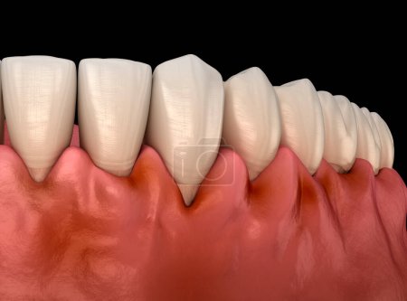 Gingivitis inflammation of the gums. Dental 3D illustration