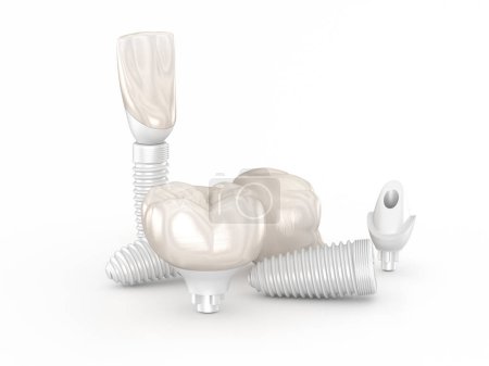 Téléchargez les photos : Implants dentaires en céramique. Illustration 3D dentaire - en image libre de droit