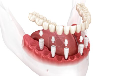 Foto de Prótesis mandibular extraíble todo en 6 sistemas soportados por implantes cerámicos. Ilustración dental 3D - Imagen libre de derechos