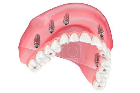 Foto de Prótesis maxilar con encía Todo en sistema 6 soportado por implantes. Ilustración dental 3D - Imagen libre de derechos