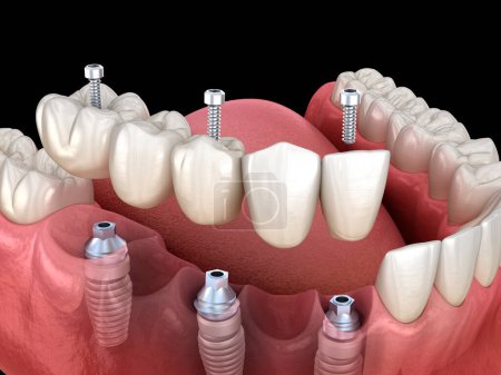Foto de Puente dental basado en 3 implantes. Ilustración dental 3D - Imagen libre de derechos