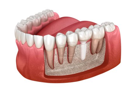 Téléchargez les photos : Installation de la couronne molaire sur implant en céramique. Illustration 3D dentaire - en image libre de droit