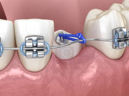 Foto de Impacto Cuspid y elástico para corrección. Ilustración dental 3D - Imagen libre de derechos