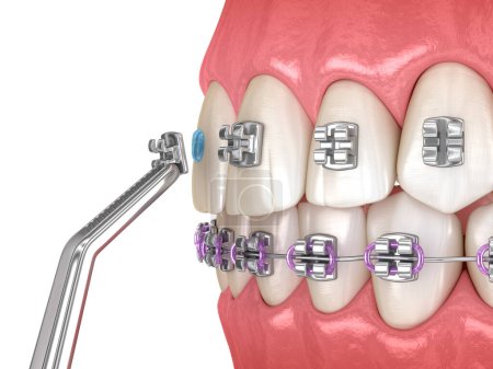 Foto de Proceso de instalación de abrazaderas metálicas. Ilustración dental 3D - Imagen libre de derechos