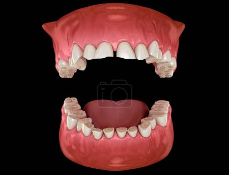 Photo for Dental attrition (Bruxism) resulting in loss of tooth tissue. Dental 3D illustration - Royalty Free Image