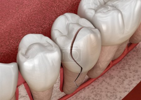 Gebrochener Zahn, gespalten. Zahnärztliche 3D-Illustration