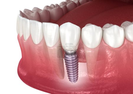 Implants dentaires et couronne en céramique. Illustration 3D dentaire médicalement précise.