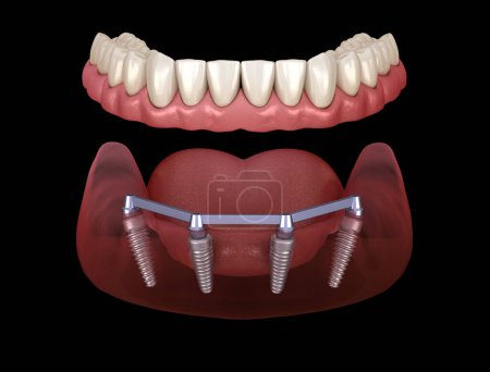 Foto de Prótesis mandibular con encía Todo en 4 sistema soportado por implantes. Ilustración 3D médicamente precisa del concepto de dientes humanos y prótesis dentales - Imagen libre de derechos