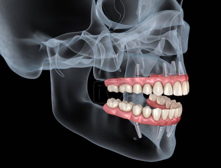 Téléchargez les photos : Prothèse maxillaire et mandibulaire avec gomme Tout sur 4 système soutenu par des implants. Illustration 3D médicalement précise des dents et prothèses humaines - en image libre de droit
