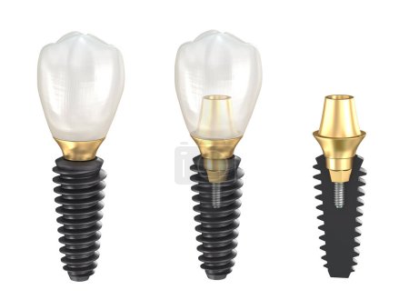 Téléchargez les photos : Implants dentaires et couronne en céramique. Illustration 3D dentaire médicalement précise. - en image libre de droit