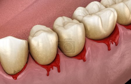 Zahnfleischbluten oder Parodontal - pathologischer entzündlicher Zustand des Zahnfleisches und der Knochenstütze. Zahnärztliche 3D-Illustration
