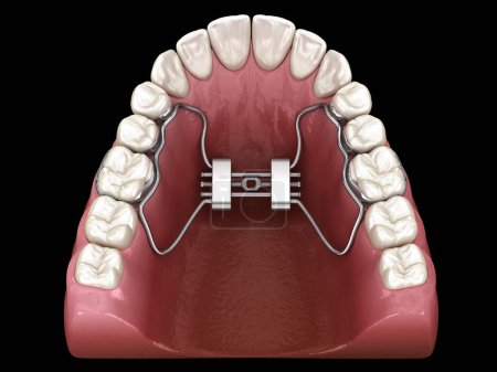 Téléchargez les photos : Expansion palatine rapide. Illustration 3D dentaire médicalement précise - en image libre de droit