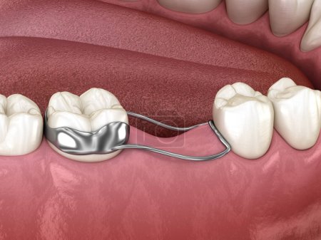 Foto de Space Maintainer Unilateral evita que los dientes cambien de deformatiuon después de perder un diente molar. Ilustración 3D - Imagen libre de derechos