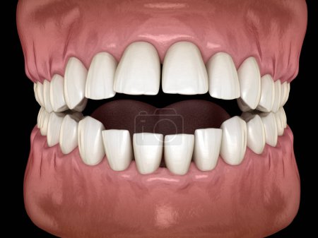 Téléchargez les photos : Occlusion dentaire ouverte (malocclusion des dents). Illustration 3D dentaire médicalement précise - en image libre de droit