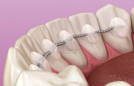 Retainers dentaires installés après le traitement des accolades, illustration 3D dentaire médicalement précise