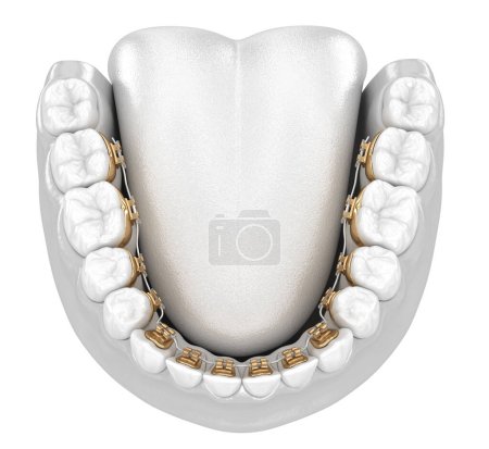 Dientes sanos con tirantes dorados, concepto de estilo blanco, ilustración 3D dental