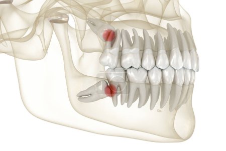 Impacto mesial de las muelas de Wisdom en el segundo molar. Ilustración 3D de dientes médicamente precisos