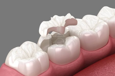 colocación de la corona de cerámica incrustación. Ilustración 3D médicamente precisa del tratamiento de dientes humanos