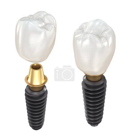 Téléchargez les photos : Implants dentaires et couronne en céramique. Illustration 3D dentaire médicalement précise. - en image libre de droit