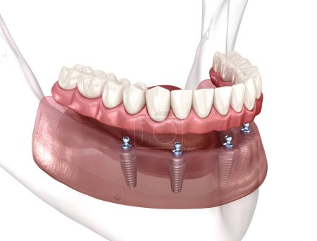 Prótesis extraíble Todo en 4 sistemas soportado por implantes. Ilustración 3D médicamente precisa del concepto de dientes humanos y prótesis dentales