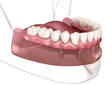 Téléchargez les photos : Prothèse amovible Tout sur 4 système soutenu par des implants. Illustration 3D médicalement précise du concept des dents et prothèses humaines - en image libre de droit