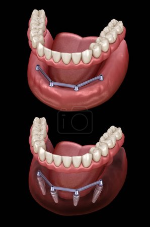 Mandibular prosthesis with gum All on 4 system supported by implants.  Medically accurate 3D illustration of human teeth and dentures concept