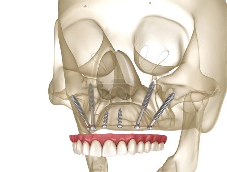 Photo for Maxillary prosthesis supported by zygomatic implants. Medically accurate 3D illustration of human teeth and dentures - Royalty Free Image