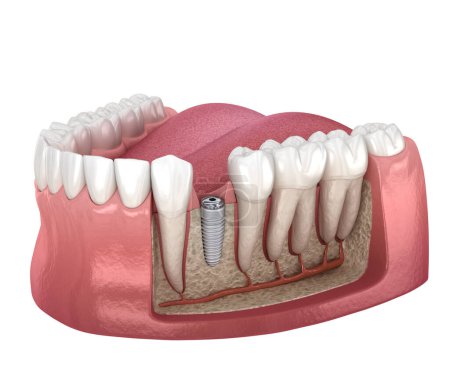 Tornillo de cubierta e implante dental. Ilustración 3D médicamente precisa.