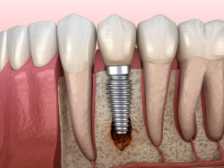 Photo for Periimplantitis with visible bone damage. Medically accurate 3D illustration - Royalty Free Image