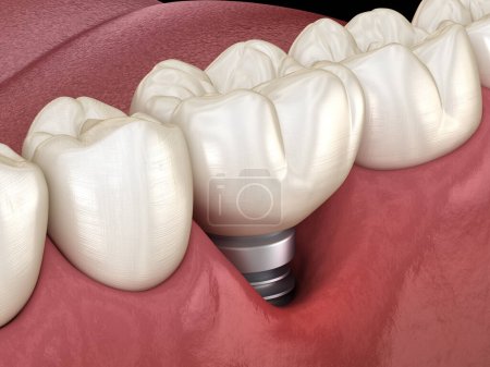 Periimplantitis mit sichtbarer Zahnfleischrezession. Medizinisch korrekte 3D-Abbildung des Zahnimplantat-Konzepts