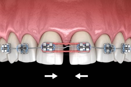 Elastiques et accolades métalliques pour la correction du diastème. Illustration 3D dentaire médicalement précise