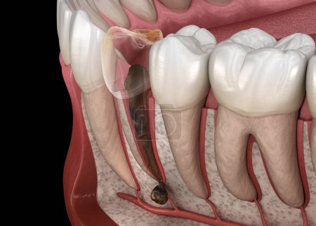 Périostite dentaire - Saute sur la gencive au-dessus de la dent. Illustration 3D dentaire