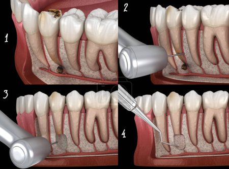 Foto de Cirugía de cistectomía dental: recuperación después de la periostitis. Ilustración dental 3D - Imagen libre de derechos