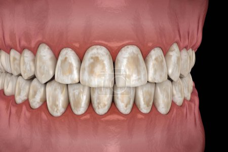 Photo for Tooth demineralization, removal of minerals from hard tissues: enamel, dentine, and cementu. Dental 3D illustration - Royalty Free Image