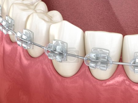 Téléchargez les photos : Mâchoire mandibulaire et bretelles claires. Illustration 3D dentaire médicalement précise - en image libre de droit