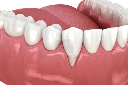 Photo for Gum Recession. 3D illustration of Dental problem - Royalty Free Image